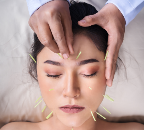 Acupuntura Estética