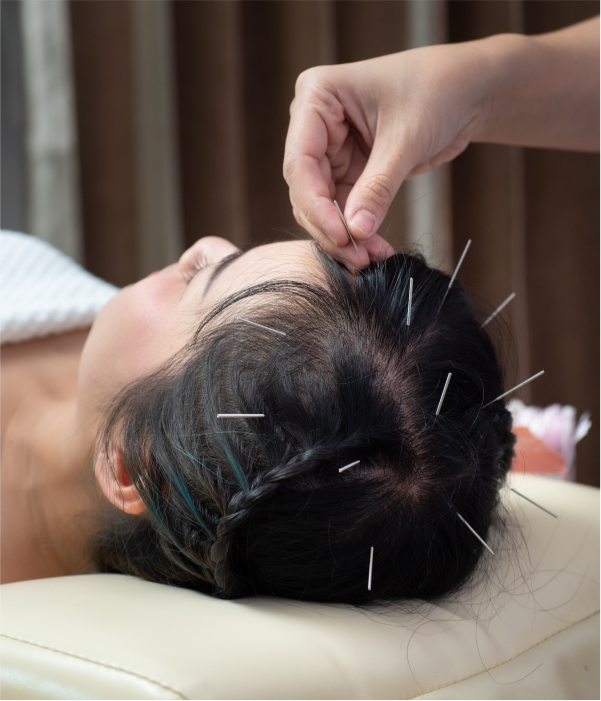 Craniopuntura de Yamamoto