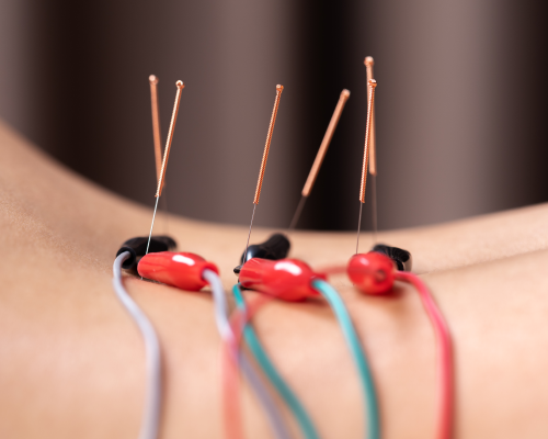 Eletroacupuntura